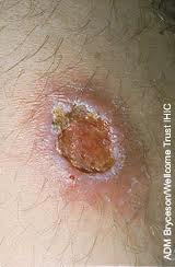 skin ulcer
